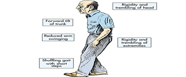 Exercise program prescription for Parkinson’s disease