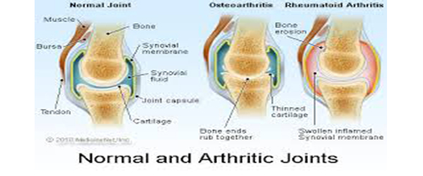 Rheumatoid Arthritis