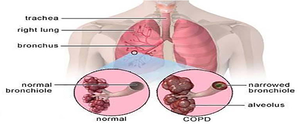 Chronic Obstructive Pulmonary Disease (COPD)