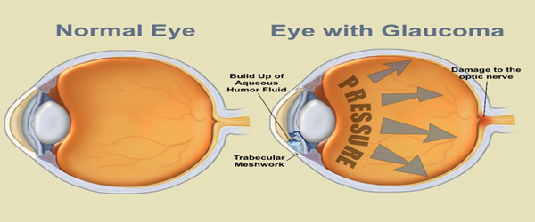 Diabetes Causes Eye Problems