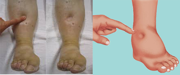 Edema