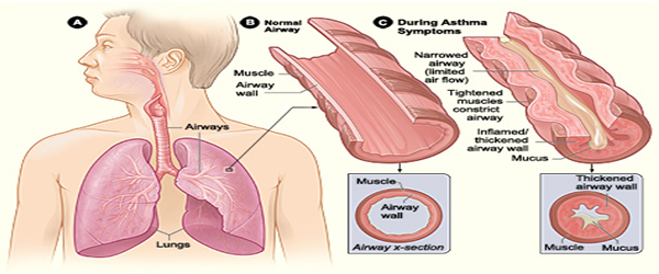 Asthma