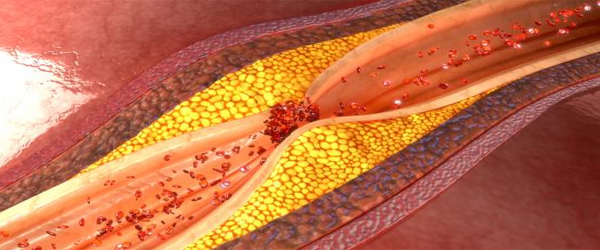Artery-clogging saturated fat myth debunked