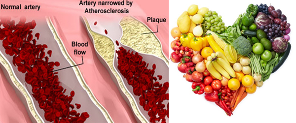 Atherosclerosis