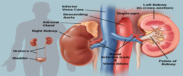 Kidney Stones